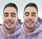 On Smile Veneers (including upper and lower jaw)
