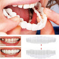 On Smile Veneers (including upper and lower jaw)
