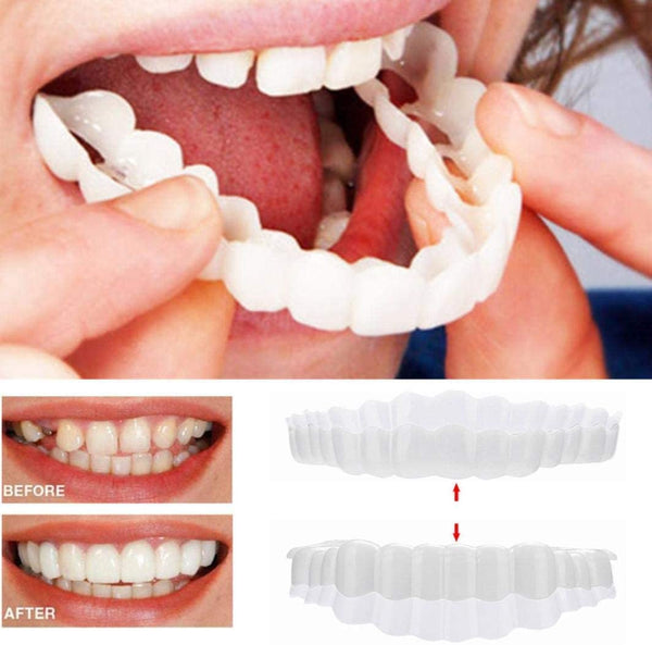 On Smile Veneers (including upper and lower jaw)